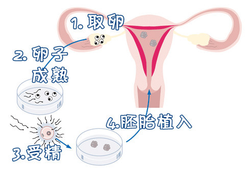 借卵生育