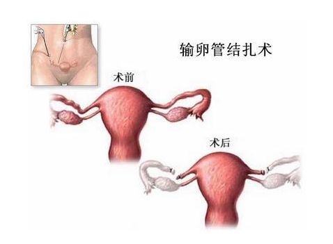 借卵试管婴儿