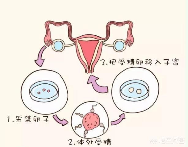 借卵做试管婴儿